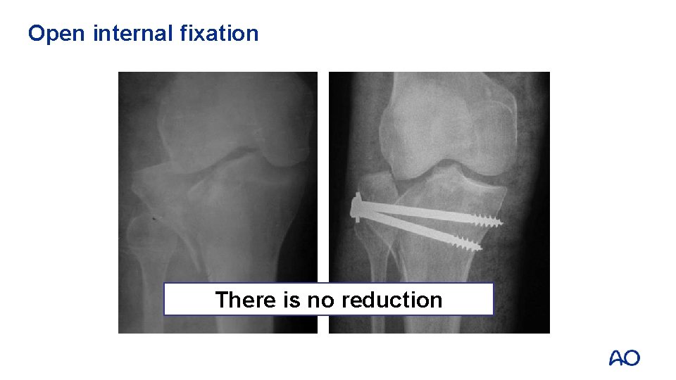 Open internal fixation There is no reduction 