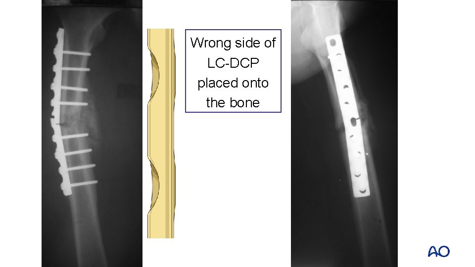 Wrong side of LC-DCP placed onto the bone 