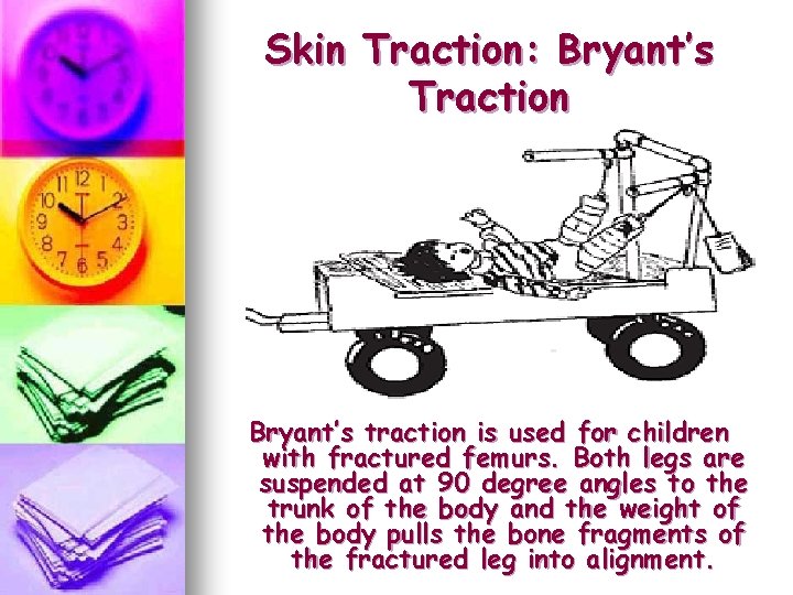 Skin Traction: Bryant’s Traction Bryant’s traction is used for children with fractured femurs. Both