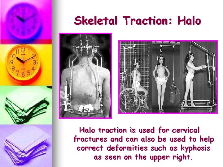 Skeletal Traction: Halo traction is used for cervical fractures and can also be used