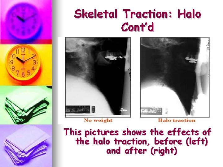 Skeletal Traction: Halo Cont’d This pictures shows the effects of the halo traction, before