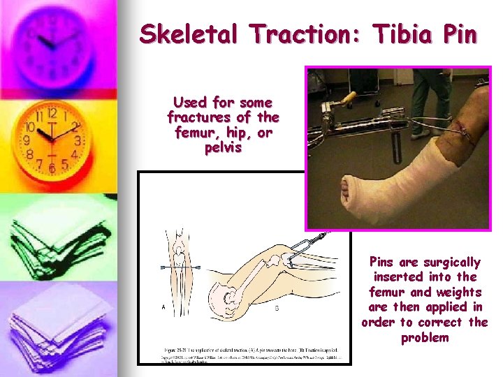 Skeletal Traction: Tibia Pin Used for some fractures of the femur, hip, or pelvis