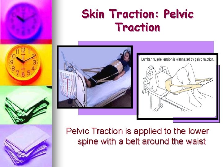 Skin Traction: Pelvic Traction is applied to the lower spine with a belt around