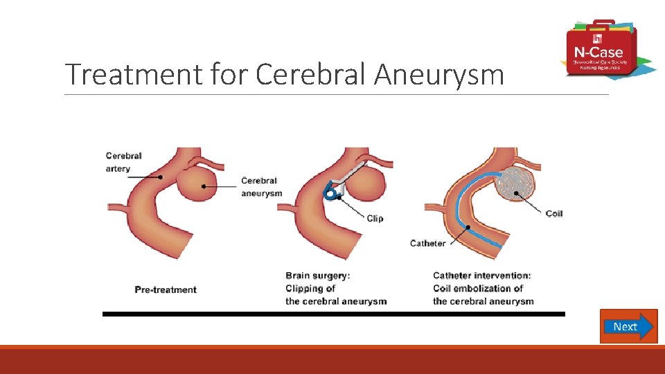 Treatment for Cerebral Aneurysm 
