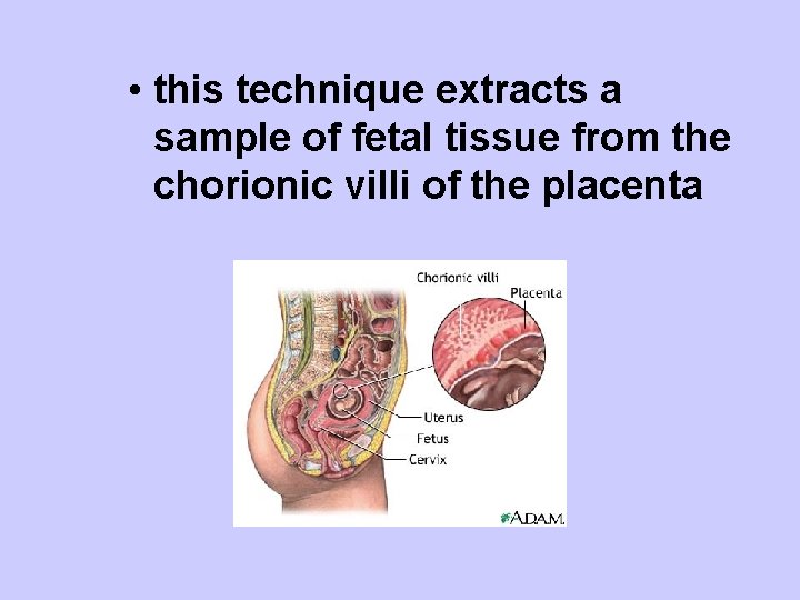  • this technique extracts a sample of fetal tissue from the chorionic villi