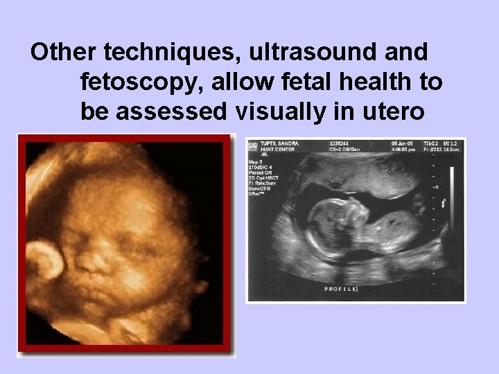 Other techniques, ultrasound and fetoscopy, allow fetal health to be assessed visually in utero