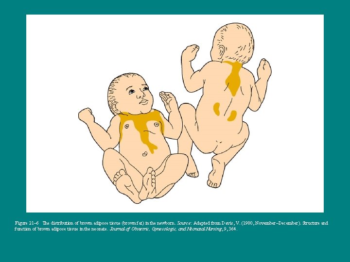 Figure 21– 6 The distribution of brown adipose tissue (brown fat) in the newborn.