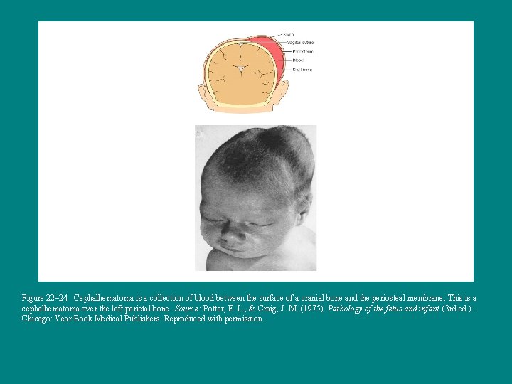 Figure 22– 24 Cephalhematoma is a collection of blood between the surface of a
