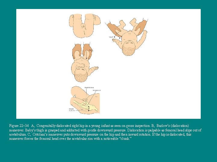 Figure 22– 34 A, Congenitally dislocated right hip in a young infant as seen