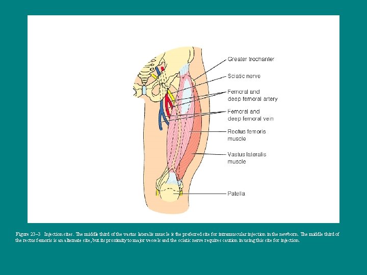 Figure 23– 3 Injection sites. The middle third of the vastus lateralis muscle is