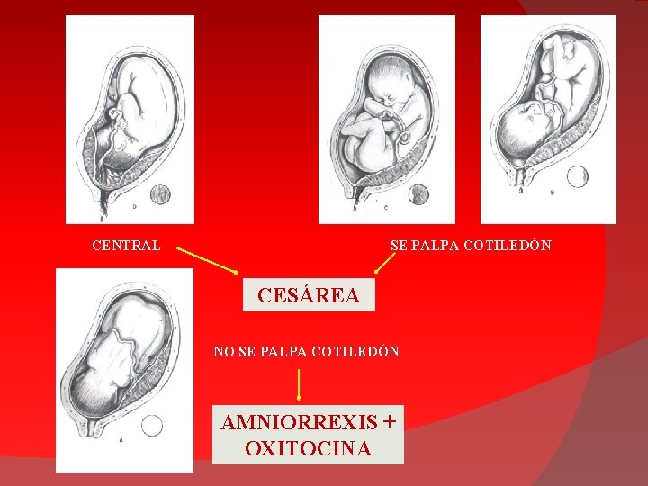 CENTRAL SE PALPA COTILEDÓN CESÁREA NO SE PALPA COTILEDÓN AMNIORREXIS + OXITOCINA 