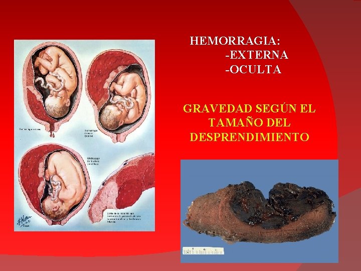 HEMORRAGIA: -EXTERNA -OCULTA GRAVEDAD SEGÚN EL TAMAÑO DEL DESPRENDIMIENTO 