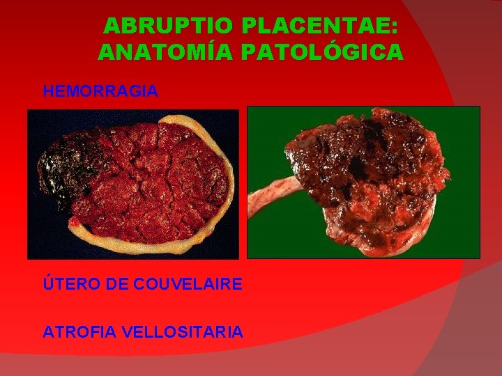 ABRUPTIO PLACENTAE: ANATOMÍA PATOLÓGICA HEMORRAGIA ÚTERO DE COUVELAIRE ATROFIA VELLOSITARIA 