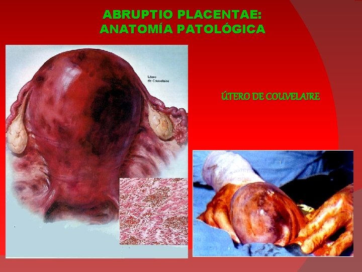 ABRUPTIO PLACENTAE: ANATOMÍA PATOLÓGICA ÚTERO DE COUVELAIRE 