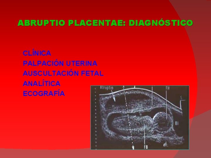 ABRUPTIO PLACENTAE: DIAGNÓSTICO CLÍNICA PALPACIÓN UTERINA AUSCULTACIÓN FETAL ANALÍTICA ECOGRAFÍA 