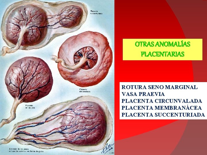 OTRAS ANOMALÍAS PLACENTARIAS ROTURA SENO MARGINAL VASA PRAEVIA PLACENTA CIRCUNVALADA PLACENTA MEMBRANÁCEA PLACENTA SUCCENTURIADA