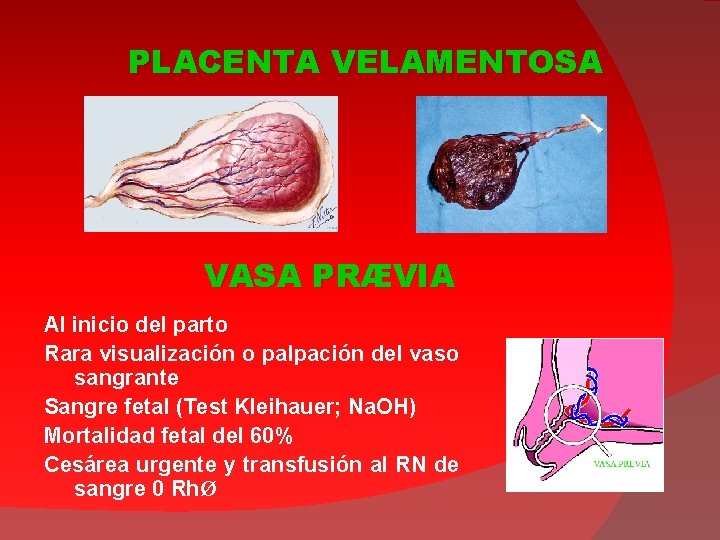 PLACENTA VELAMENTOSA VASA PRÆVIA Al inicio del parto Rara visualización o palpación del vaso