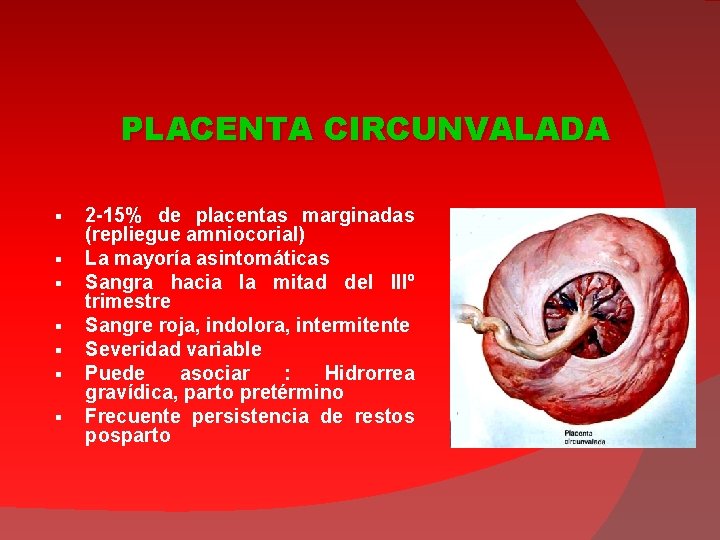 PLACENTA CIRCUNVALADA § § § § 2 -15% de placentas marginadas (repliegue amniocorial) La