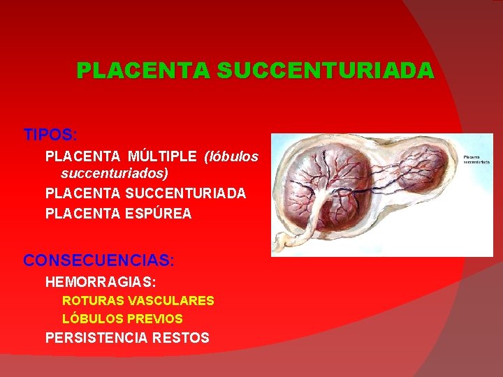 PLACENTA SUCCENTURIADA TIPOS: PLACENTA MÚLTIPLE (lóbulos succenturiados) PLACENTA SUCCENTURIADA PLACENTA ESPÚREA CONSECUENCIAS: HEMORRAGIAS: ROTURAS