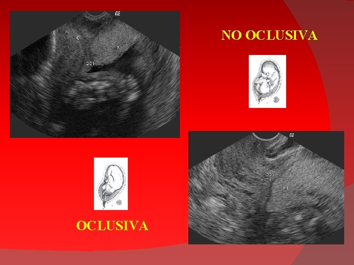 NO OCLUSIVA 