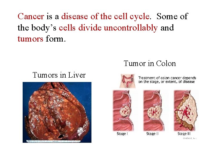 Cancer is a disease of the cell cycle. Some of the body’s cells divide