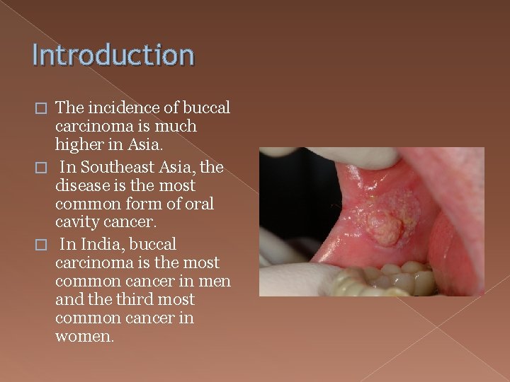 Introduction The incidence of buccal carcinoma is much higher in Asia. � In Southeast