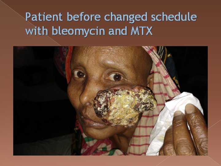 Patient before changed schedule with bleomycin and MTX 