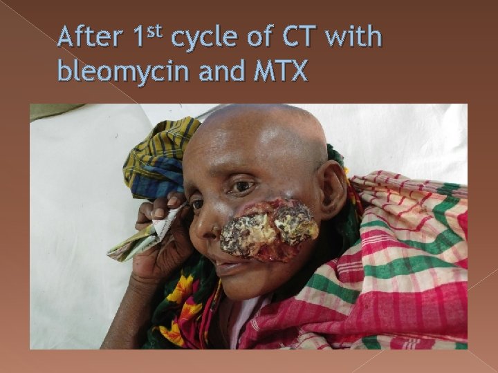 After 1 st cycle of CT with bleomycin and MTX 