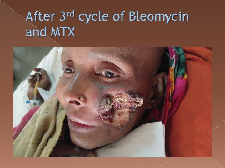 After 3 rd cycle of Bleomycin and MTX 