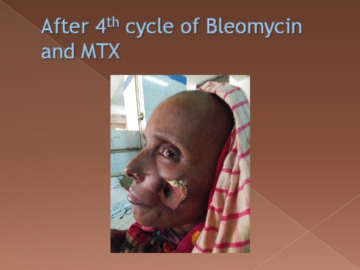 After 4 th cycle of Bleomycin and MTX 