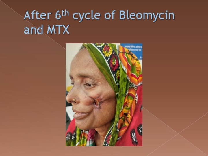 After 6 th cycle of Bleomycin and MTX 