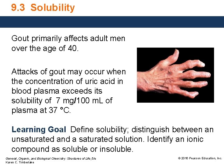 9. 3 Solubility Gout primarily affects adult men over the age of 40. Attacks
