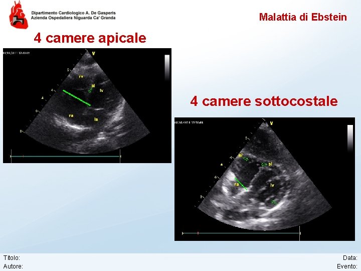 Malattia di Ebstein 4 camere apicale 4 camere sottocostale Titolo: Autore: Data: Evento: 