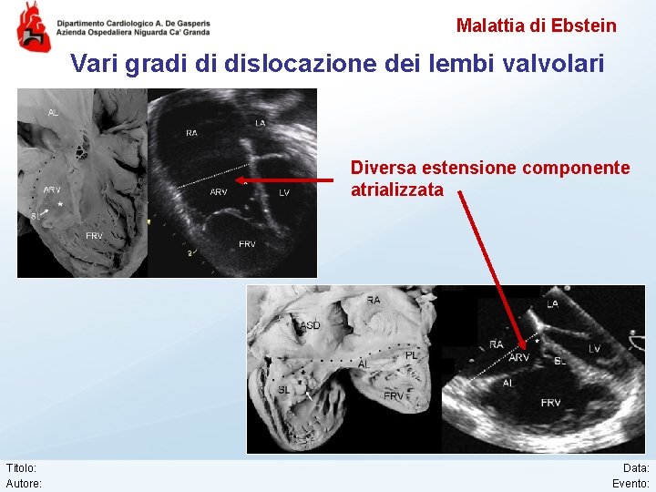 Malattia di Ebstein Vari gradi di dislocazione dei lembi valvolari Diversa estensione componente atrializzata