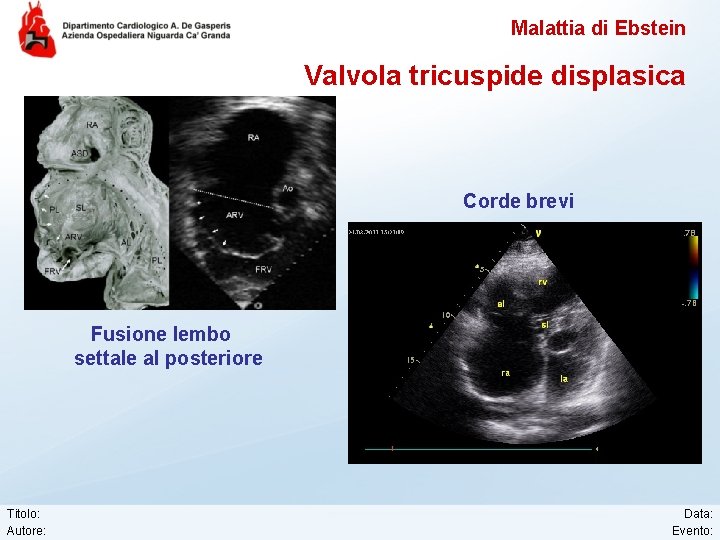 Malattia di Ebstein Valvola tricuspide displasica Corde brevi Fusione lembo settale al posteriore Titolo: