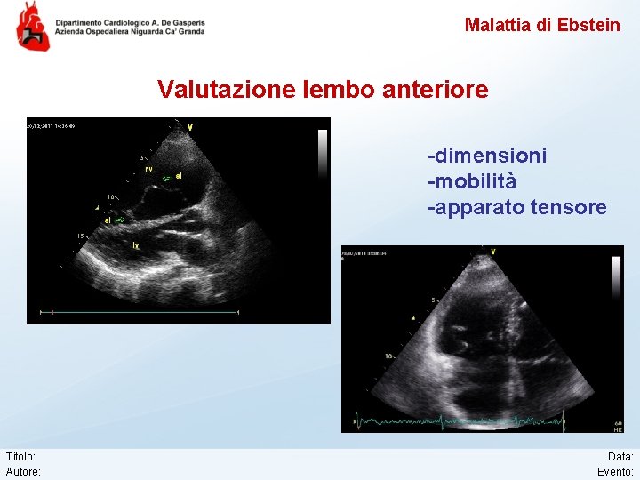 Malattia di Ebstein Valutazione lembo anteriore -dimensioni -mobilità -apparato tensore Titolo: Autore: Data: Evento: