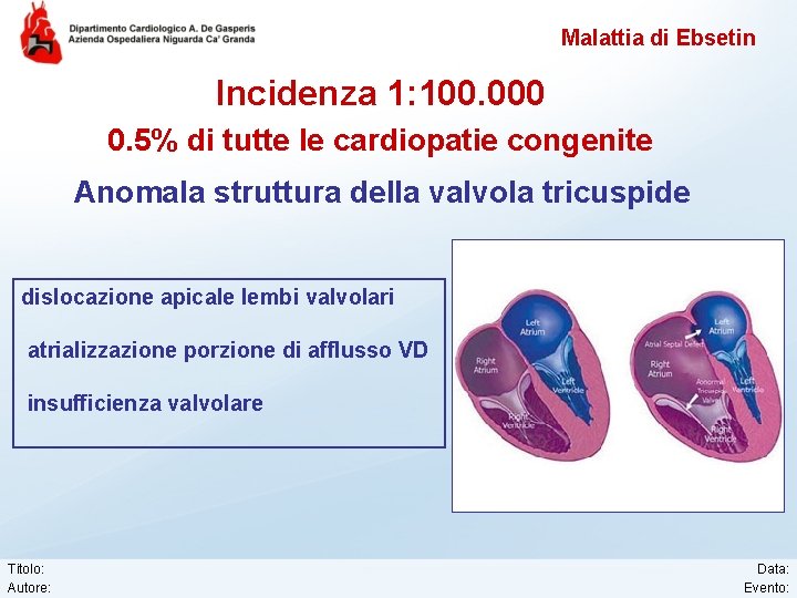 Malattia di Ebsetin Incidenza 1: 100. 000 0. 5% di tutte le cardiopatie congenite