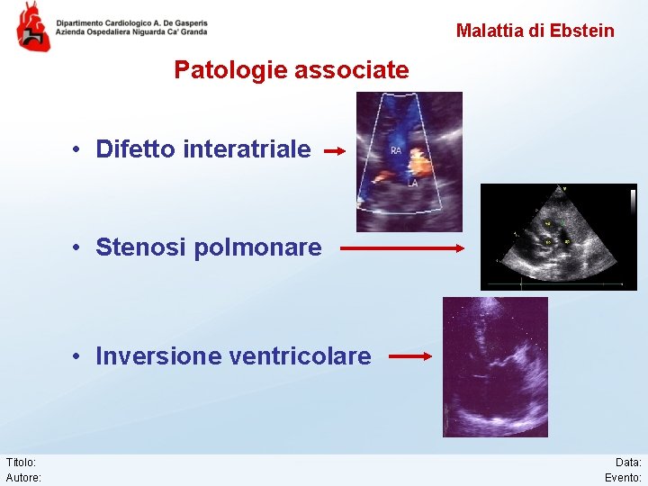 Malattia di Ebstein Patologie associate • Difetto interatriale • Stenosi polmonare • Inversione ventricolare