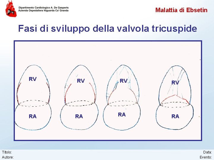 Malattia di Ebsetin Fasi di sviluppo della valvola tricuspide Titolo: Autore: RV RV RA