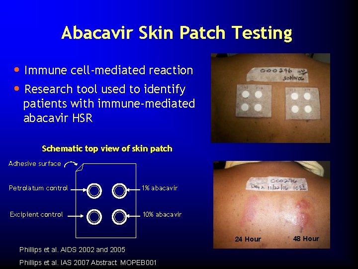 Abacavir Skin Patch Testing • Immune cell-mediated reaction • Research tool used to identify