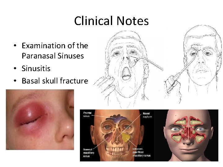 Clinical Notes • Examination of the Paranasal Sinuses • Sinusitis • Basal skull fracture