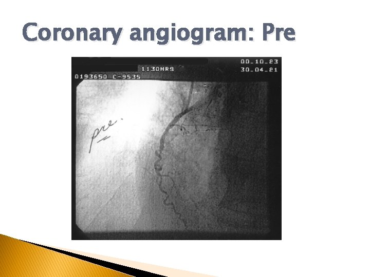 Coronary angiogram: Pre Coronary angiogram: Pre