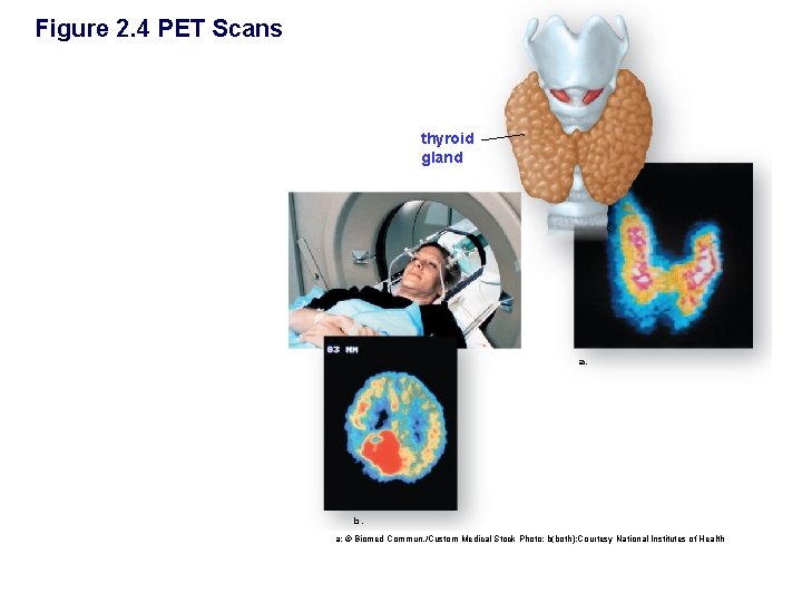 Figure 2. 4 PET Scans thyroid gland a. b. a: © Biomed Commun. /Custom