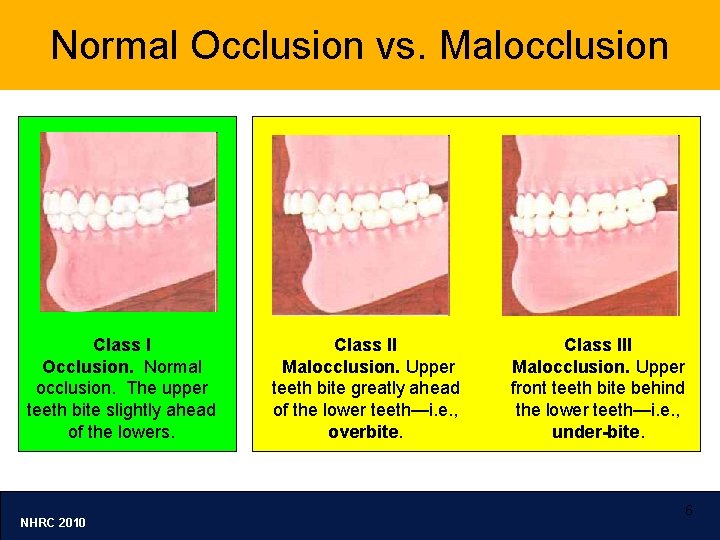 Normal Occlusion vs. Malocclusion Class I Occlusion. Normal occlusion. The upper teeth bite slightly