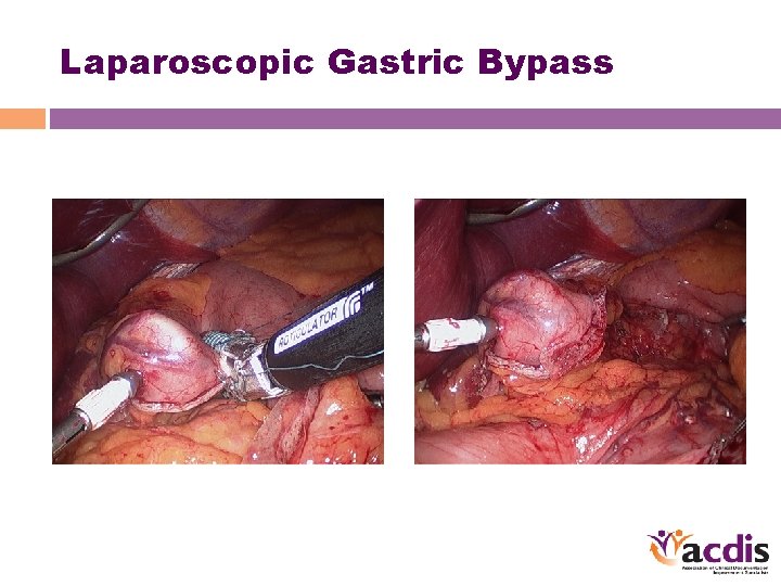 Laparoscopic Gastric Bypass 