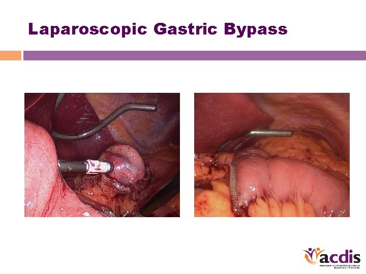 Laparoscopic Gastric Bypass 