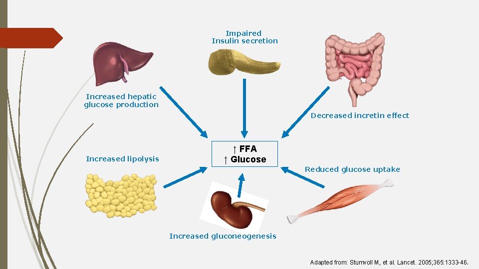 Impaired Insulin secretion Increased hepatic glucose production Decreased incretin effect Increased lipolysis ↑ FFA