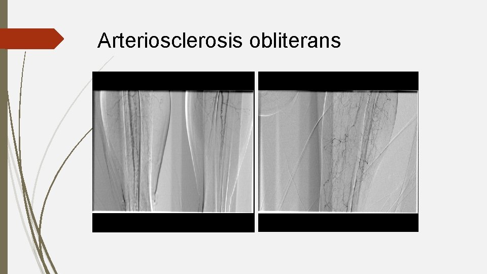 Arteriosclerosis obliterans 