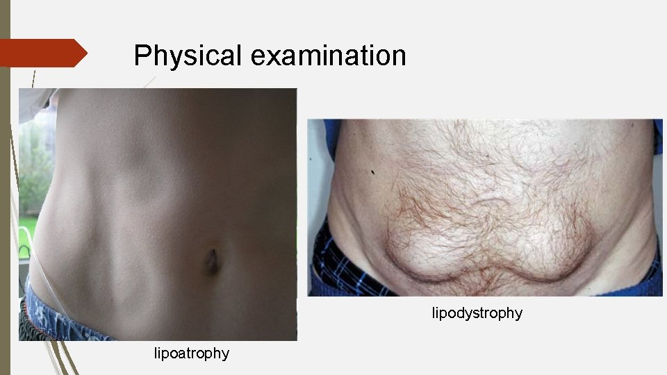 Physical examination lipodystrophy lipoatrophy 