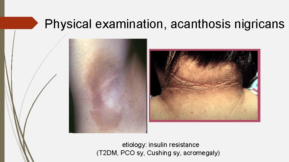 Physical examination, acanthosis nigricans etiology: insulin resistance (T 2 DM, PCO sy, Cushing sy,